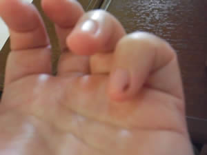 左手の小指の爪が内出血
